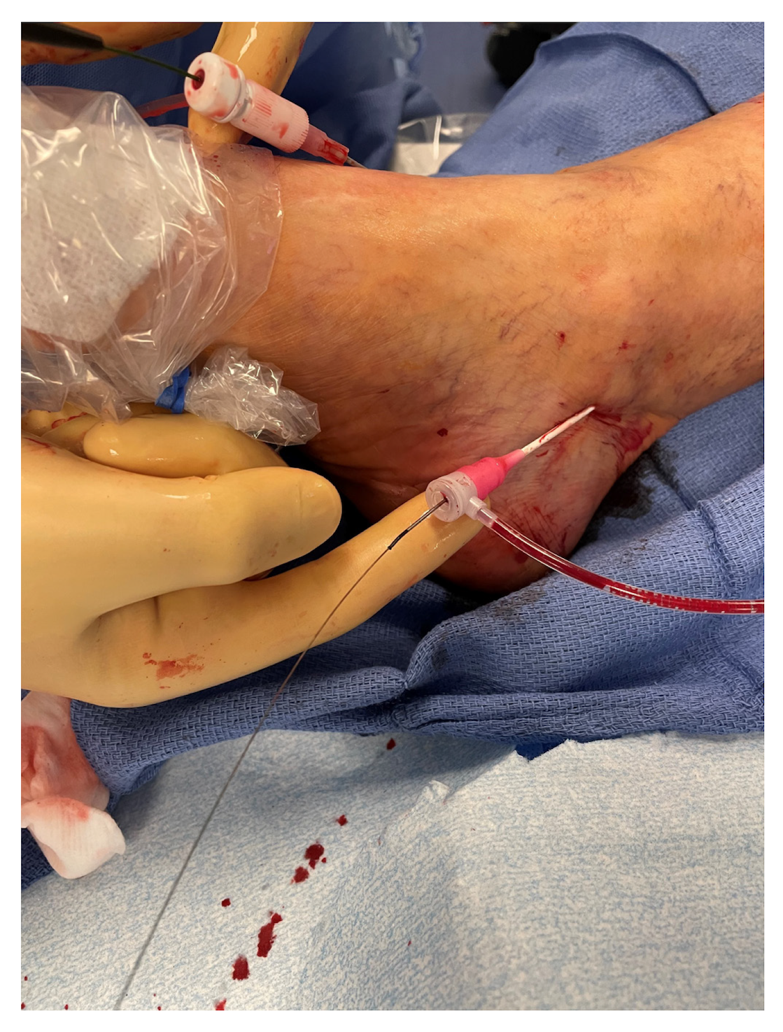 Mustapha Figure 1. Retrograde pedal access of the posterior tibial artery
