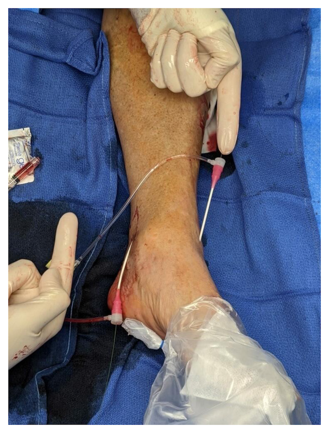 Mustapha Figure 2. Dual retrograde posterior tibial artery access