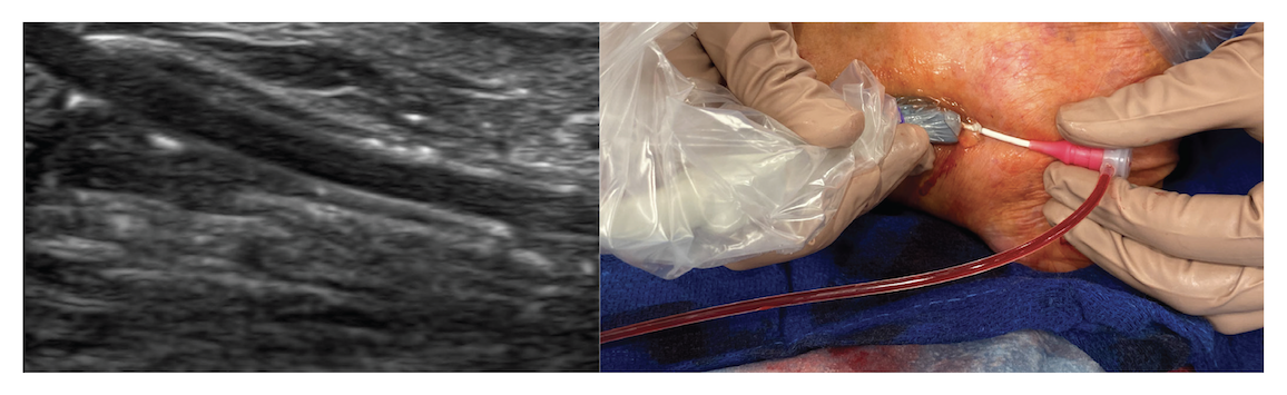 Figure 3. Extravascular ultrasound (EVUS) image