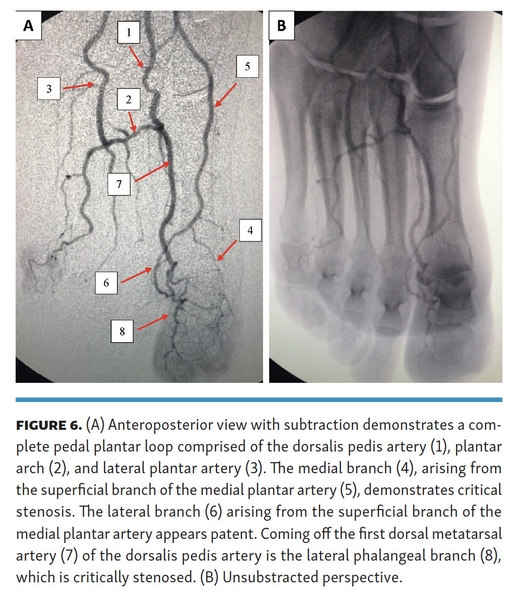 Pyon Impact of Performing  Lower-Extremity Angiographic Intervention Beyond the Pedal Plantar Loop Fig 6