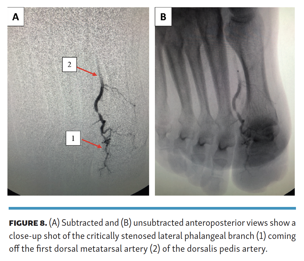 Pyon Impact of Performing  Lower-Extremity Angiographic Intervention Beyond the Pedal Plantar Loop Fig 8