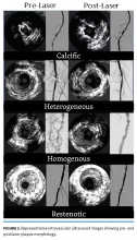 Adams IVUS Fig1