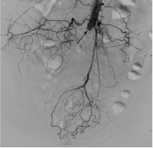 Kapoor IVL for Calcification in Aortoiliac and CFA Reconstruction Fig 1